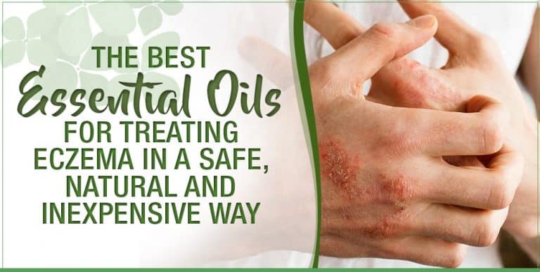 The Best Essential Oils For Treating Eczema In A Safe Natural And Inexpensive Way Essential 3202