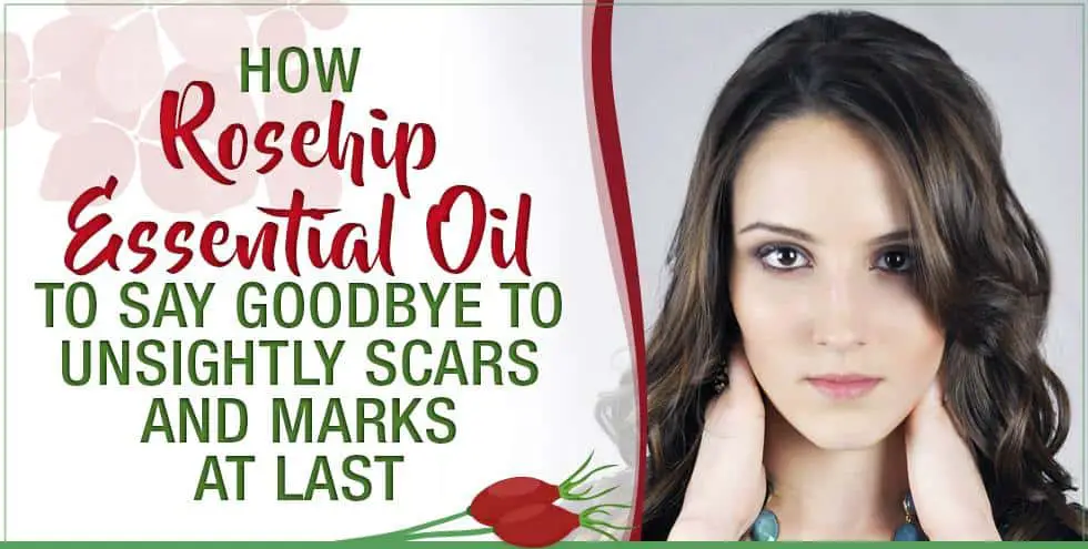 Use Rosehip Essential Oil To Say Goodbye To Unsightly Scars And Marks ...